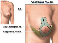 Подтяжка груди схема операции
