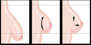 Ступінь опущення грудей для планування мастопексії