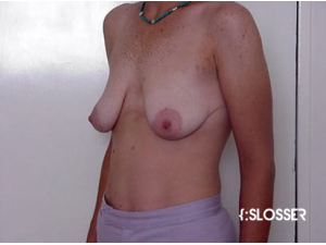 Увеличение груди и мастопексия - Фото 1