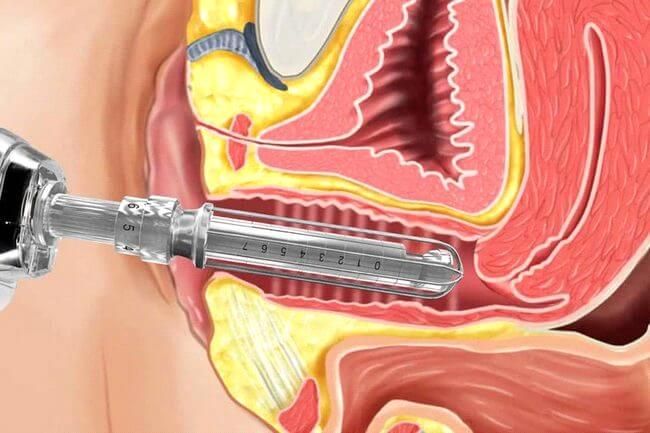 Как можно использовать лазерные процедуры для вагинального омоложения? | SLOSSER