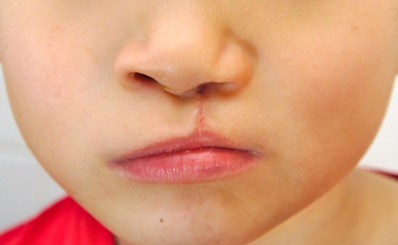Що таке операція по відновленню розщілини губи і піднебіння? | SLOSSER