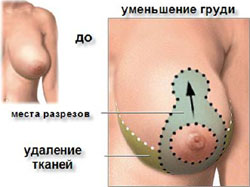 варианты уменьшения груди