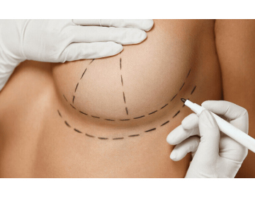 Что такое уменьшение груди и каковы преимущества этой процедуры?