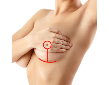 Эффективные типы подтяжки груди