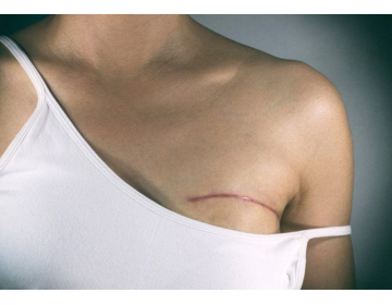 Реконструкция груди: стоимость без имплантов, белья