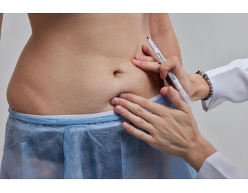 Body-contouring после быстрой потери веса: что нужно знать пациенту