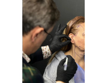 Morpheus8 or Surgical Neck Lift: What to Choose for the Chin and Neck Area