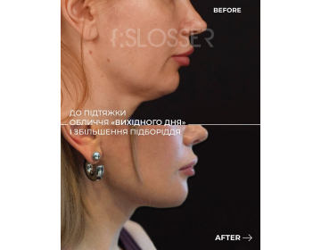 Подтяжка «выходного дня» – самый эффективный способ подтяжки лица