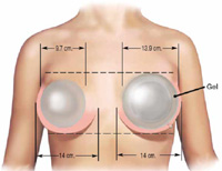 Ассиметрия груди- установка разных имплантов