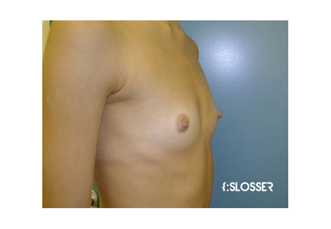 Увеличение груди имплантом МакГан объёмом 225 мл - Фото 2