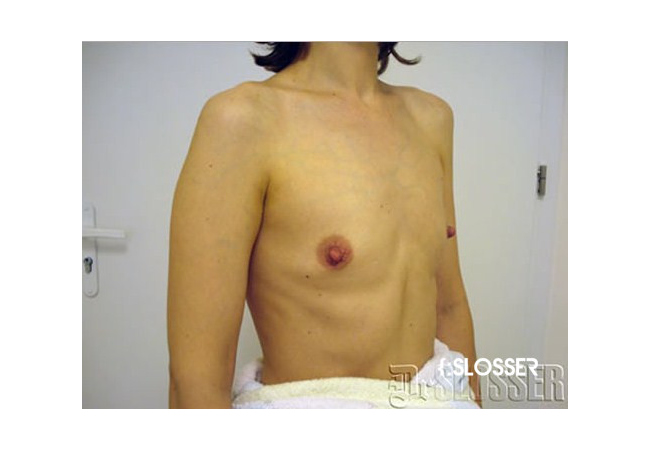 Увеличение груди имплантами MacGhan 410 стиль - Фото 2