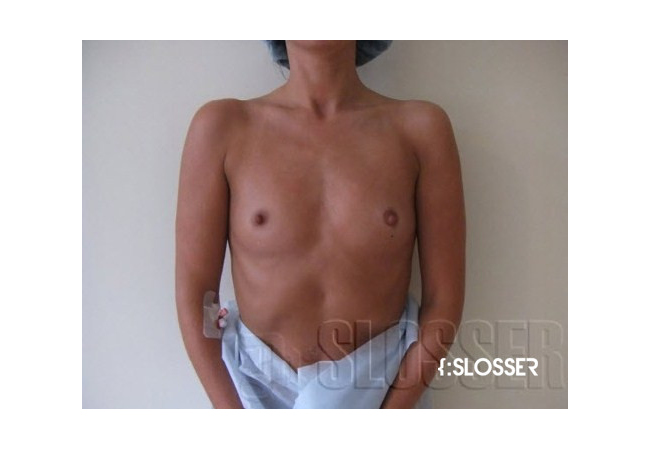 Увеличение груди от нулевого до третьего размера - Фото 2