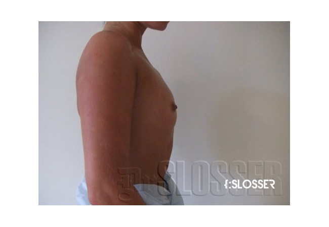 Увеличение груди от нулевого до третьего размера - Фото 6