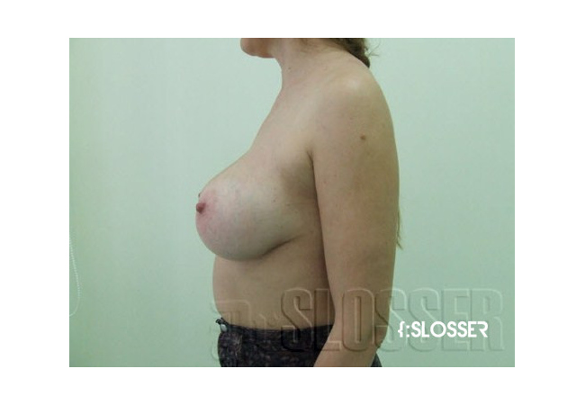 Увеличение груди для придания ей наполненности - Фото 7