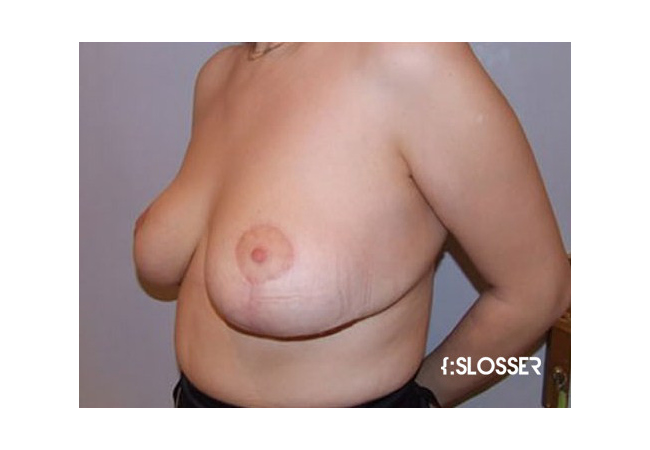 Уменьшение груди по технике Robbins - Фото 1