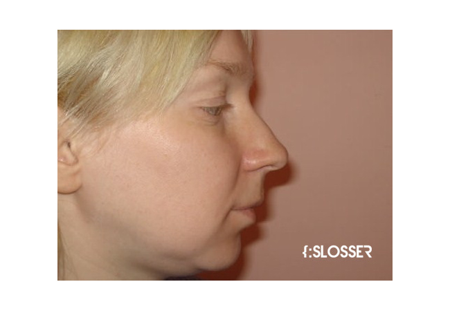 Коррекция кончика носа и ноздрей - Фото 6