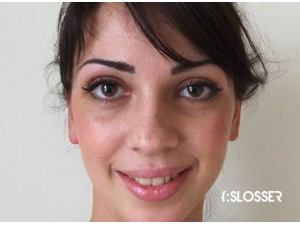 Незначительная коррекция спинки носа и кончика носа - Фото 1