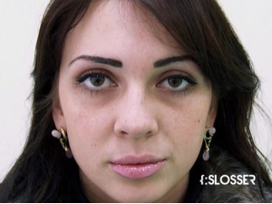 Незначительная коррекция спинки носа и кончика носа - Фото 1