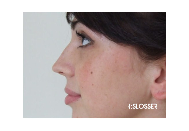 Незначительная коррекция спинки носа и кончика носа - Фото 6