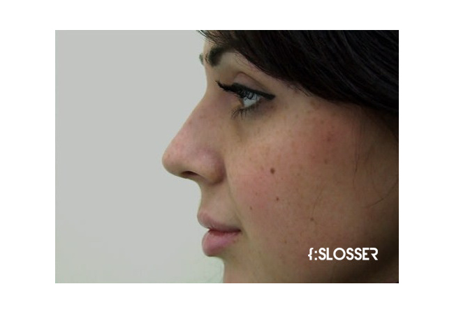 Незначительная коррекция спинки носа и кончика носа - Фото 5