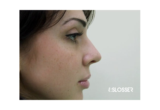 Незначительная коррекция спинки носа и кончика носа - Фото 7