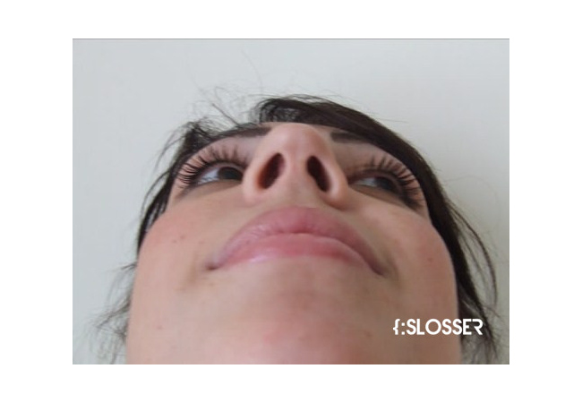 Незначительная коррекция спинки носа и кончика носа - Фото 10