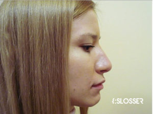 Відновлення естетичних пропорцій носа - Фото 1