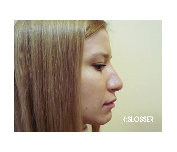 Восстановление эстетических пропорций носа