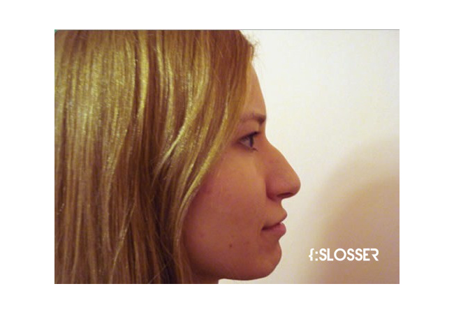 Восстановление эстетических пропорций носа - Фото 2