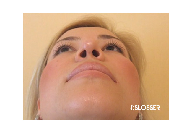 Зменшення проекції кінчика носа і корекція лівої ніздрі - Фото 9