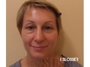 Омолаживающая блефаропластика - Фото 1