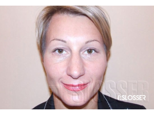 Омолаживающая блефаропластика - Фото 1