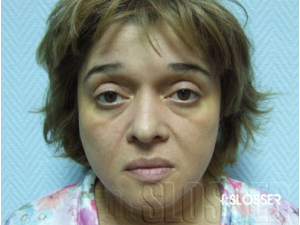 Процедура имиджевой блефаропластики - Фото 1