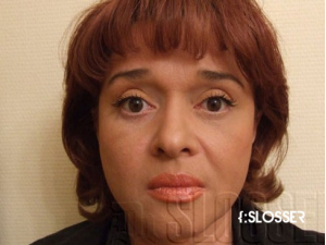 Процедура имиджевой блефаропластики - Фото 1