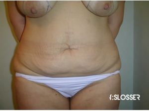 Абдоминопластика с одновременным уменьшением груди - Фото 1