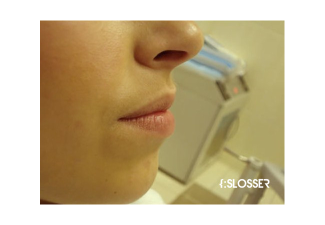 Отличный результат увеличения губ хирургическим методом- фото пациентки - Фото 2