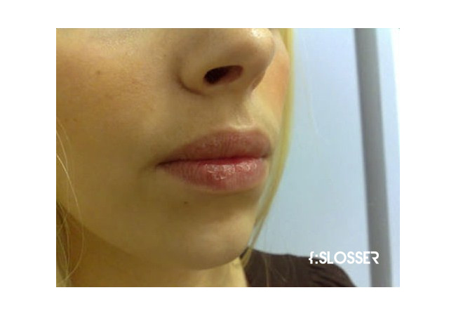 Отличный результат увеличения губ хирургическим методом- фото пациентки - Фото 1