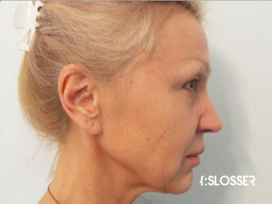Подтяжка лица  SMAS техника и увеличение губ - Фото 1