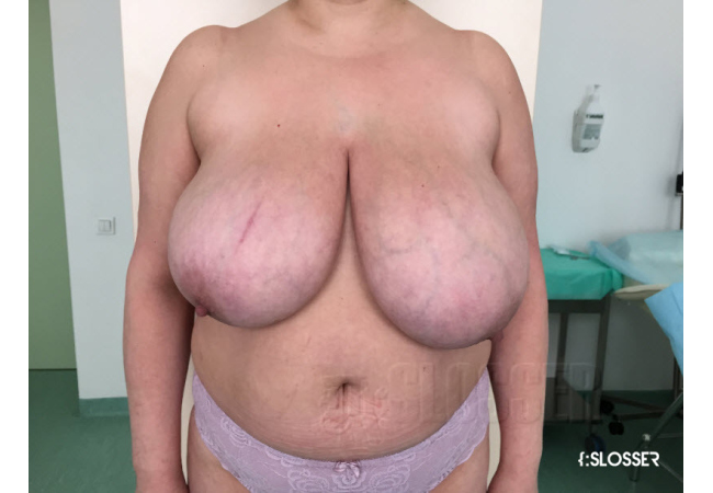 Уменьшение груди по Robbins - Фото 12