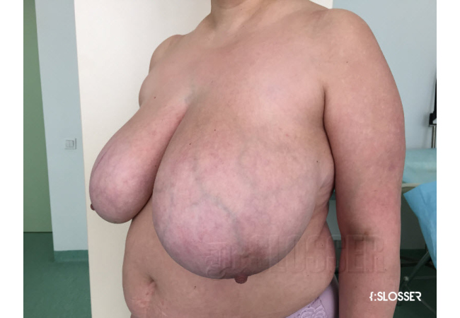 Уменьшение груди по Robbins - Фото 8