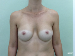 Увеличение груди при микромастии - Фото 1