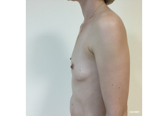 Увеличение груди при микромастии - Фото 10