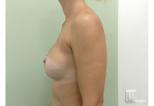 Увеличение груди при микромастии - Фото 3