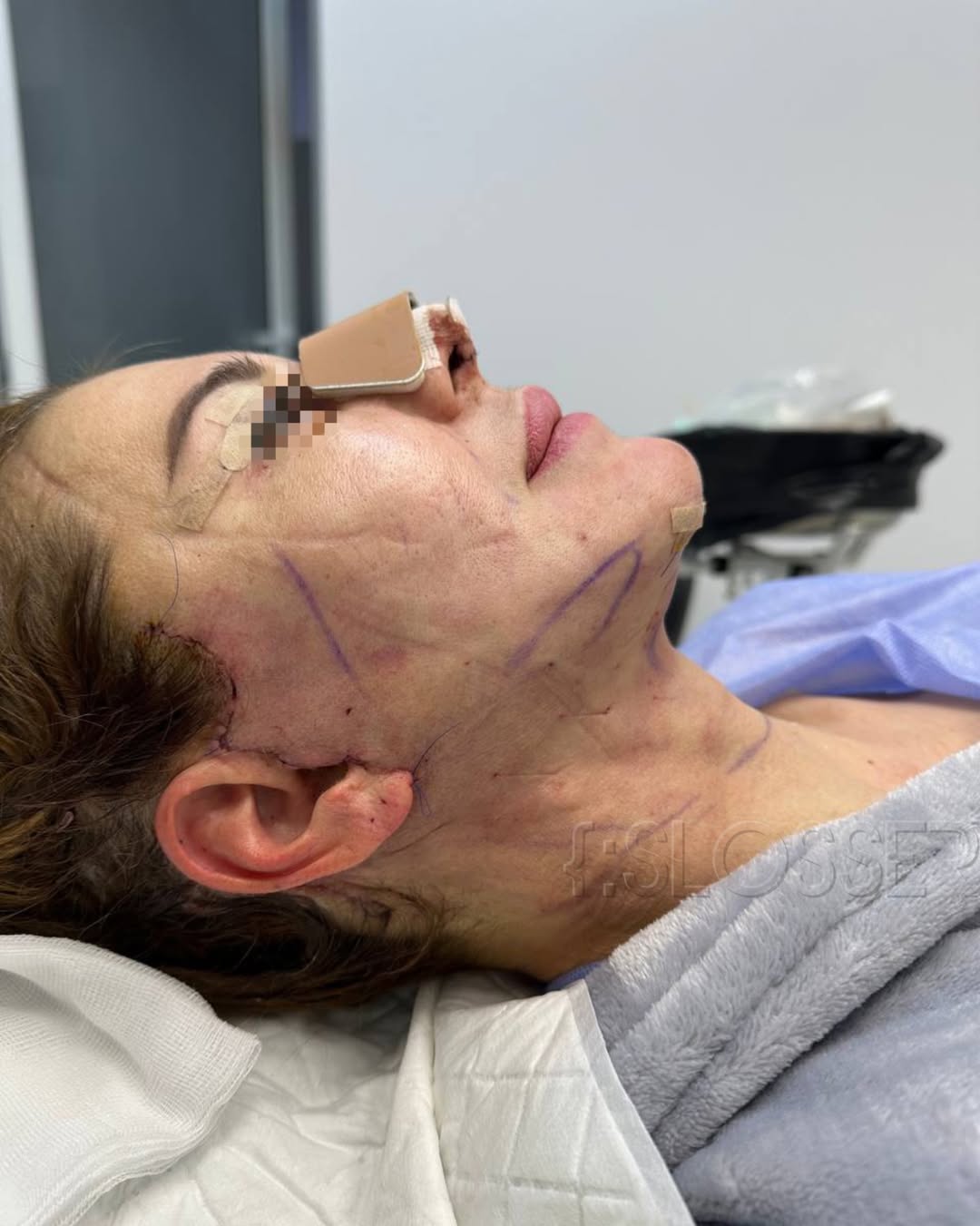 Endoscopic Lift vs. Weekend Lift: What Patients Choose After 35