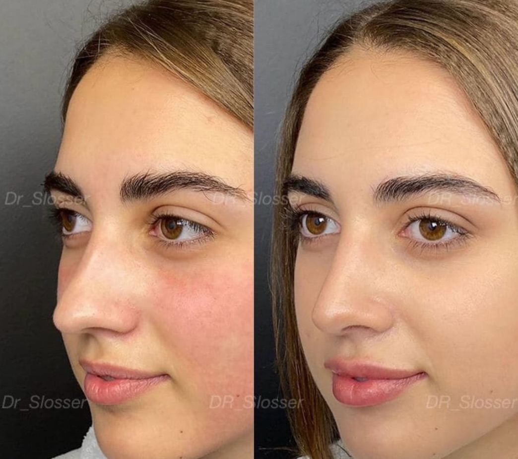 Slosser_Dmytro_How to Correct the Shape of the Nose and Restore Breathing While Preserving Individuality