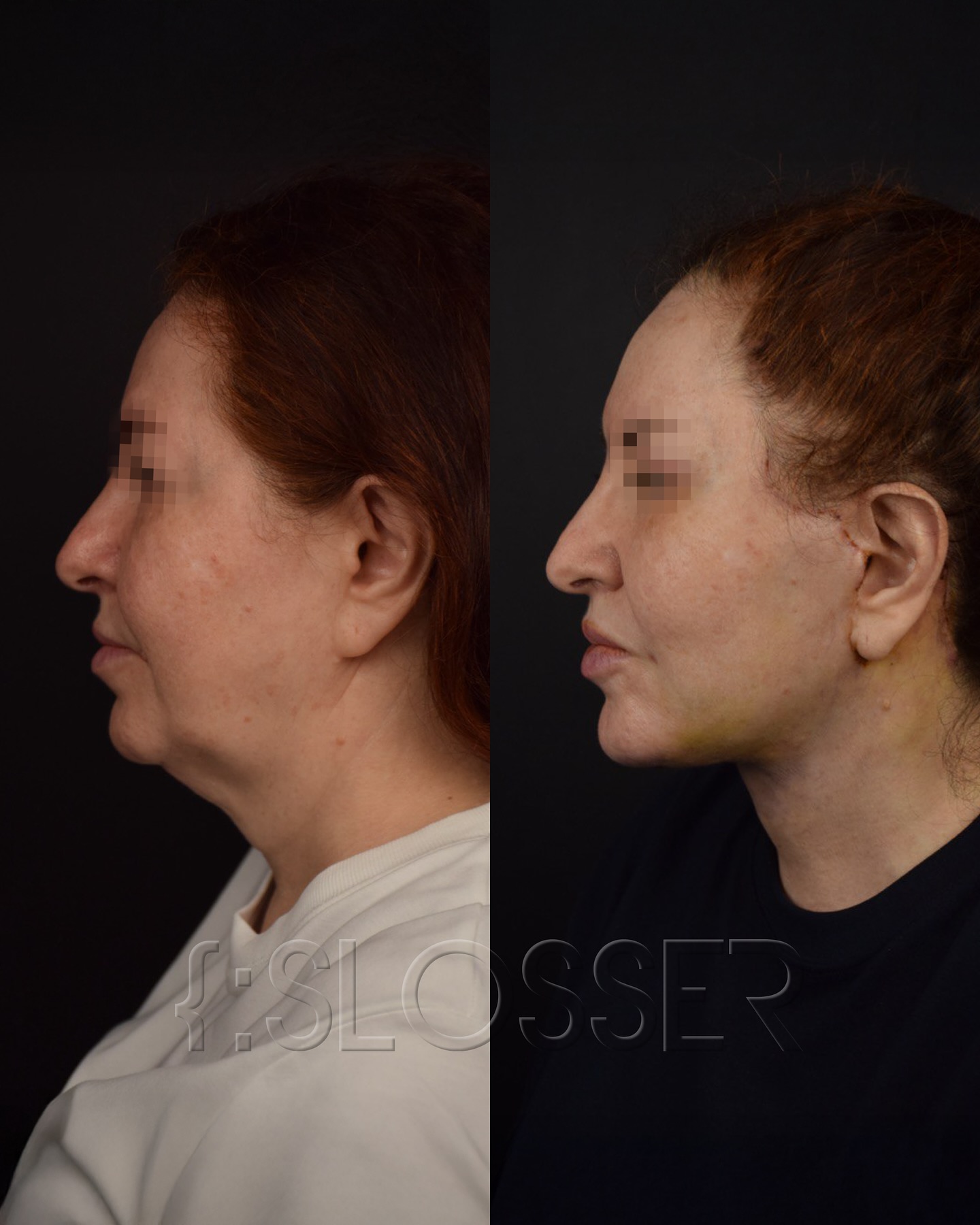 Quiet Plastic Surgery: The Leading Rejuvenation Trend of 2026