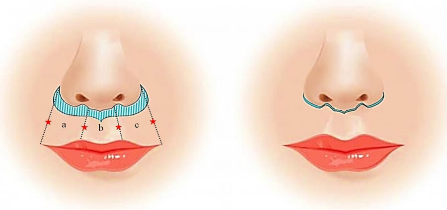 Upper Lip Lift Without Fillers: When a Lip Lift Offers a More Natural Result Than Hyaluronic Acid