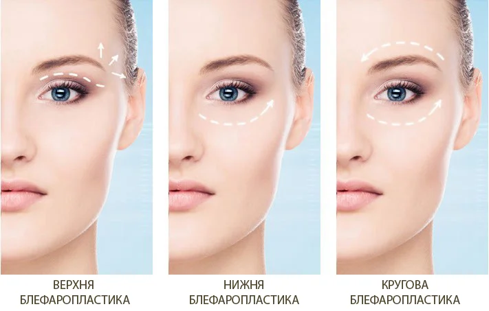 slosser_dmytro_Modern Blepharoplasty: Everything About Eye Rejuvenation, Procedure Stages, and Recovery