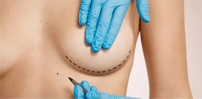 dmytro_slosser_The Rise of Natural Aesthetics: Why Small Breast Implants Became the Top Choice in 2026