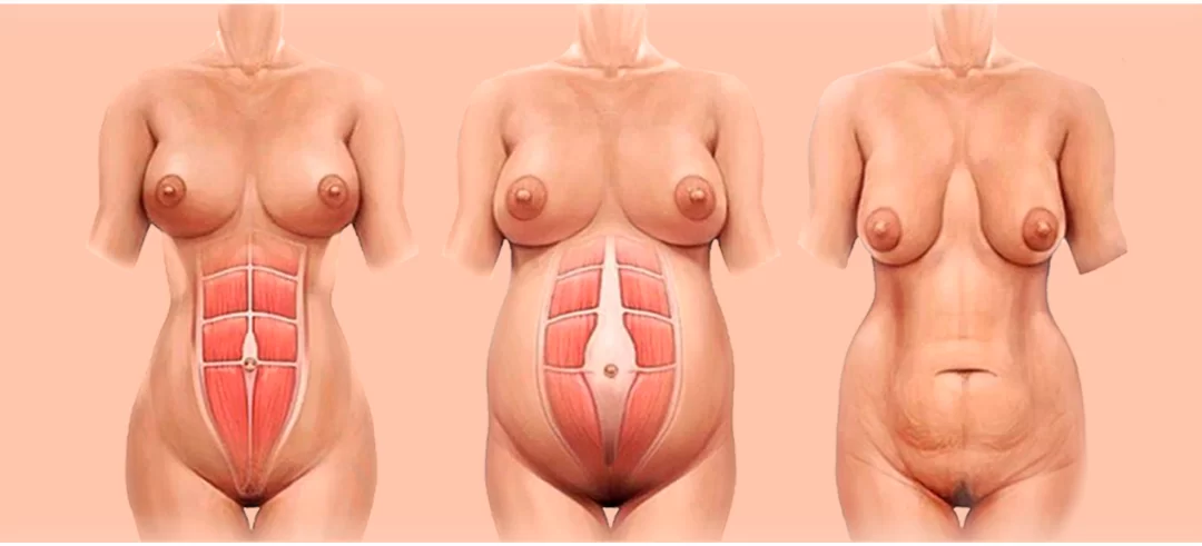 What Happens to the Body After Childbirth and How Plastic Surgery Can Help: A Plastic Surgeon’s Perspective